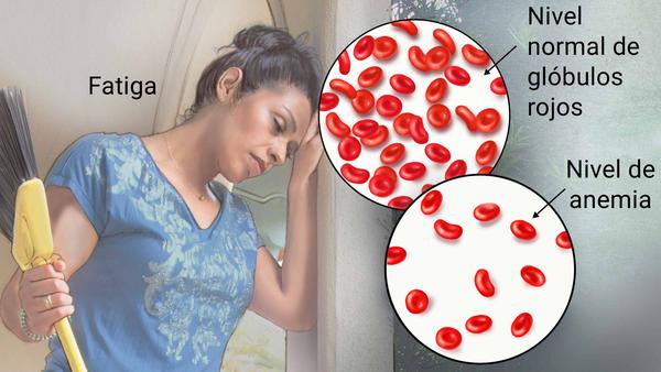 Anemia por Deficiencia de Hierro: Detectando y Combatiendo la Fatiga