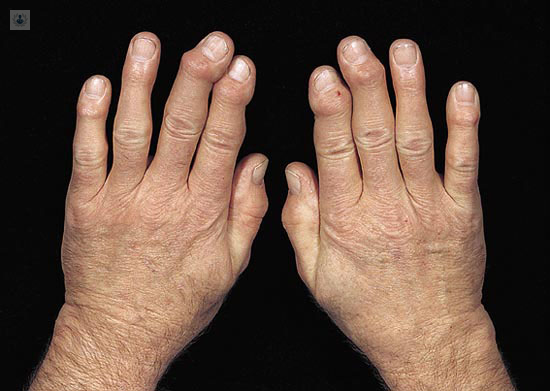 Osteoartritis: Comprendiendo los Factores de Riesgo detrás del Desgaste Articular